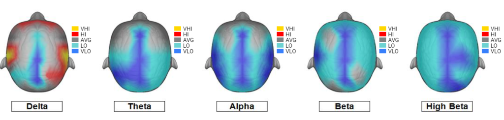 Example 1 of post Huachuma brain map