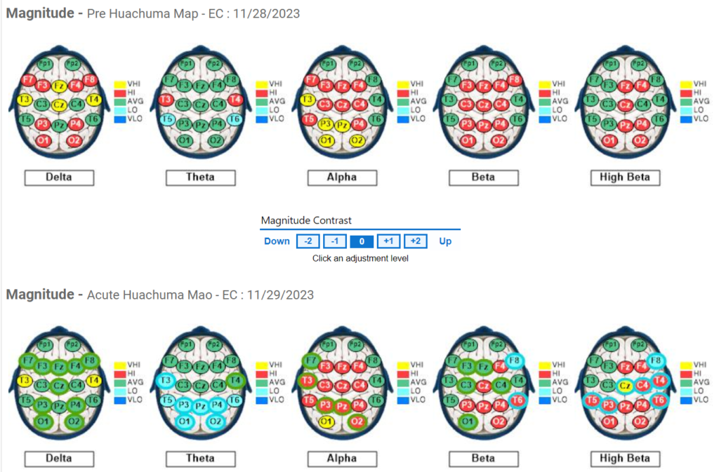 Subject #1 Pre and Post QEEG Results