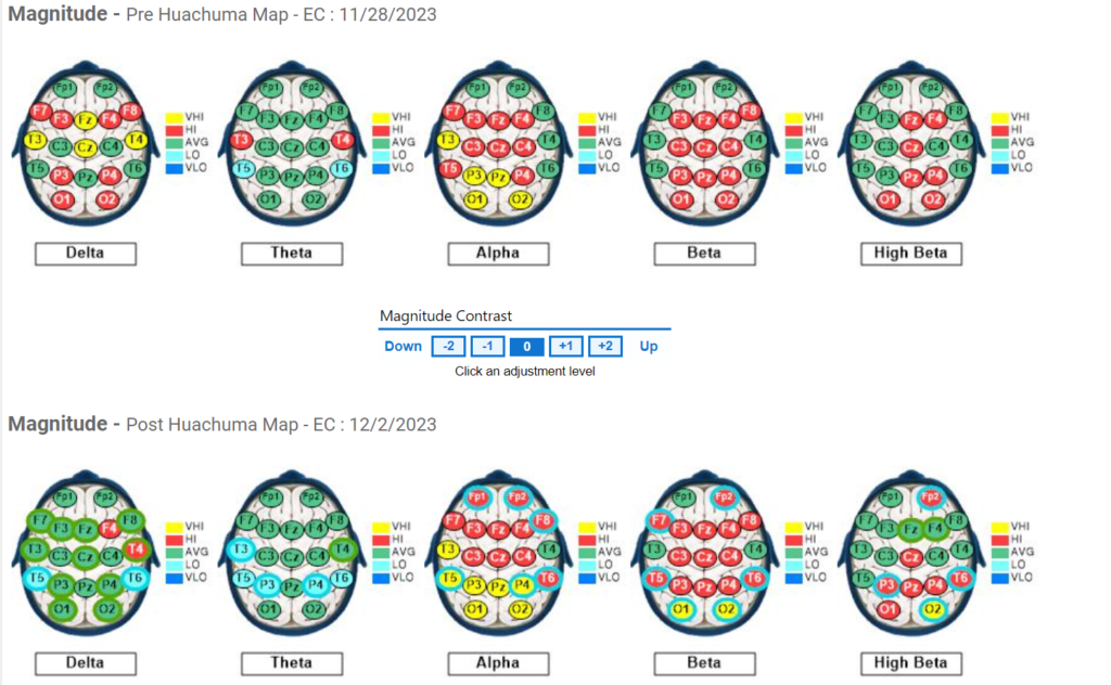 Subject #1 Pre and Post QEEG Results