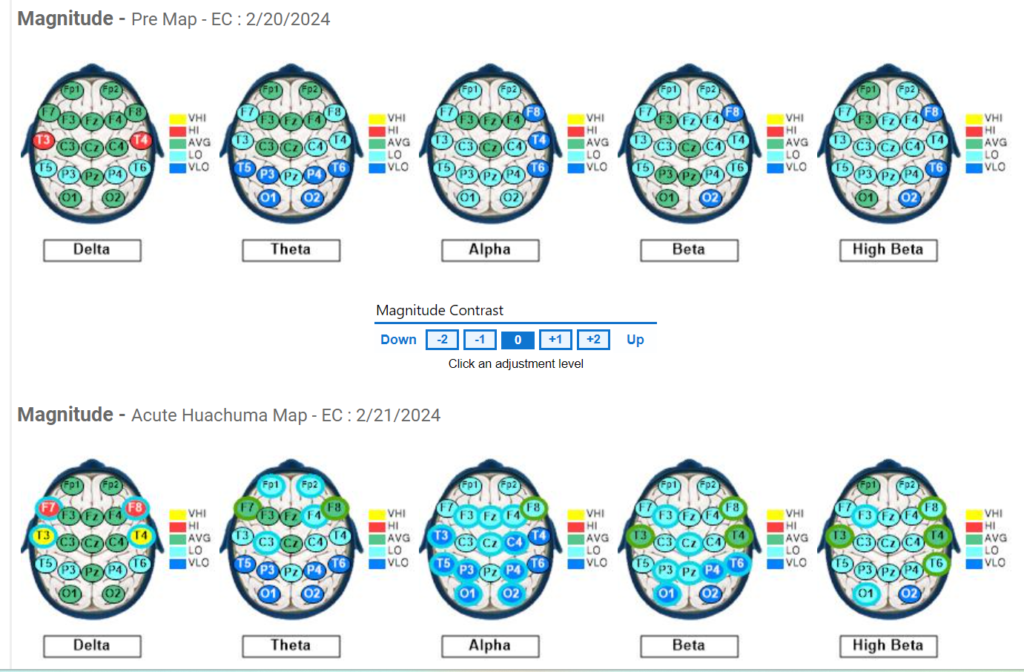 Subject #10 Pre and Acute QEEG results