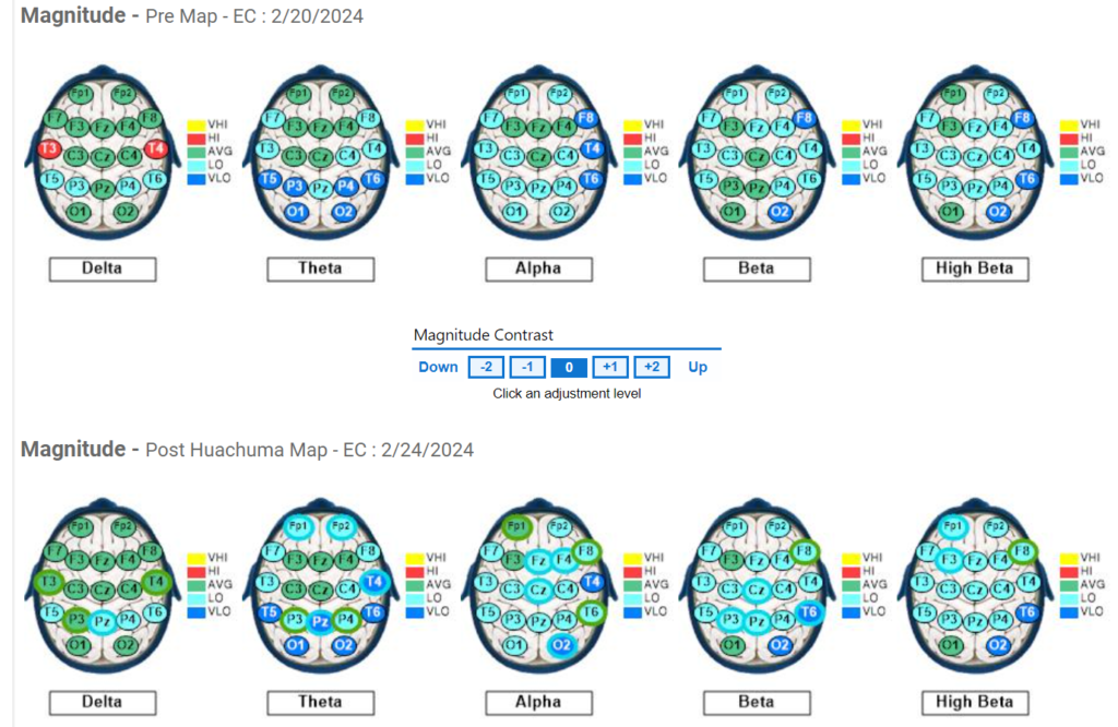 Subject #10 Pre and Post QEEG results