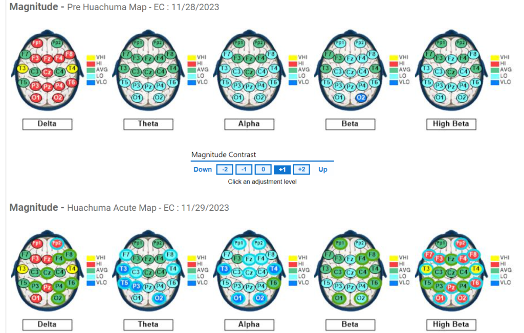 Subject #2 Pre and Post QEEG results