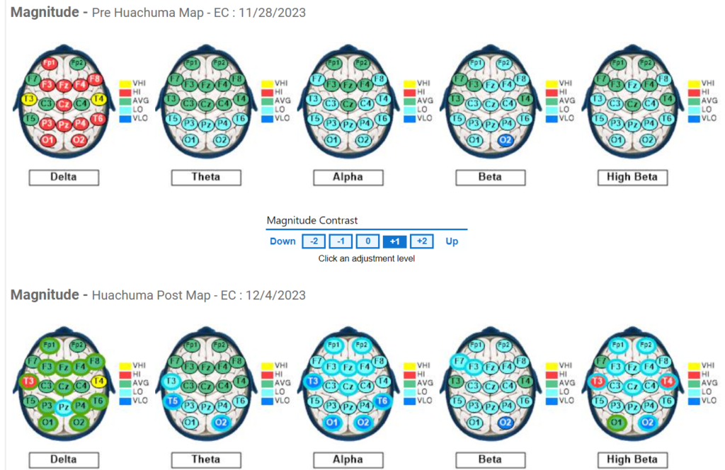 Subject #2 Pre and Post QEEG results