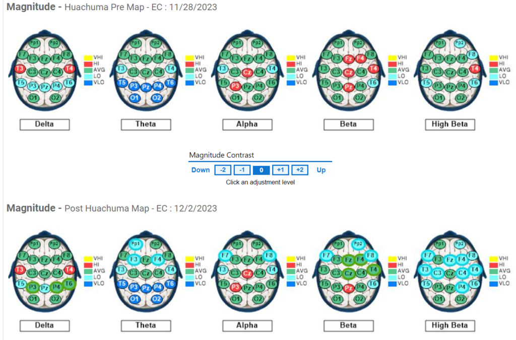 Subject #3 Pre and Post QEEG Results