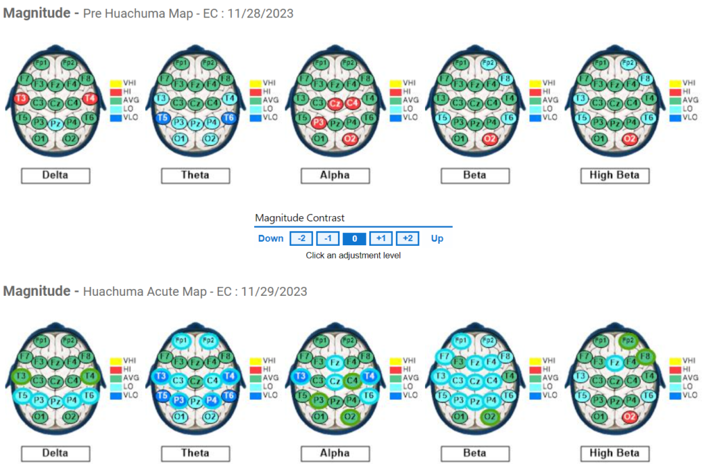 Subject 4 Pre and Acute QEEG results