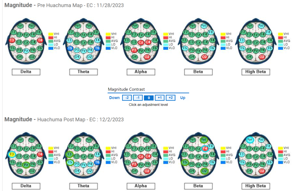 Subject #4 QEEG Pre and Post Results