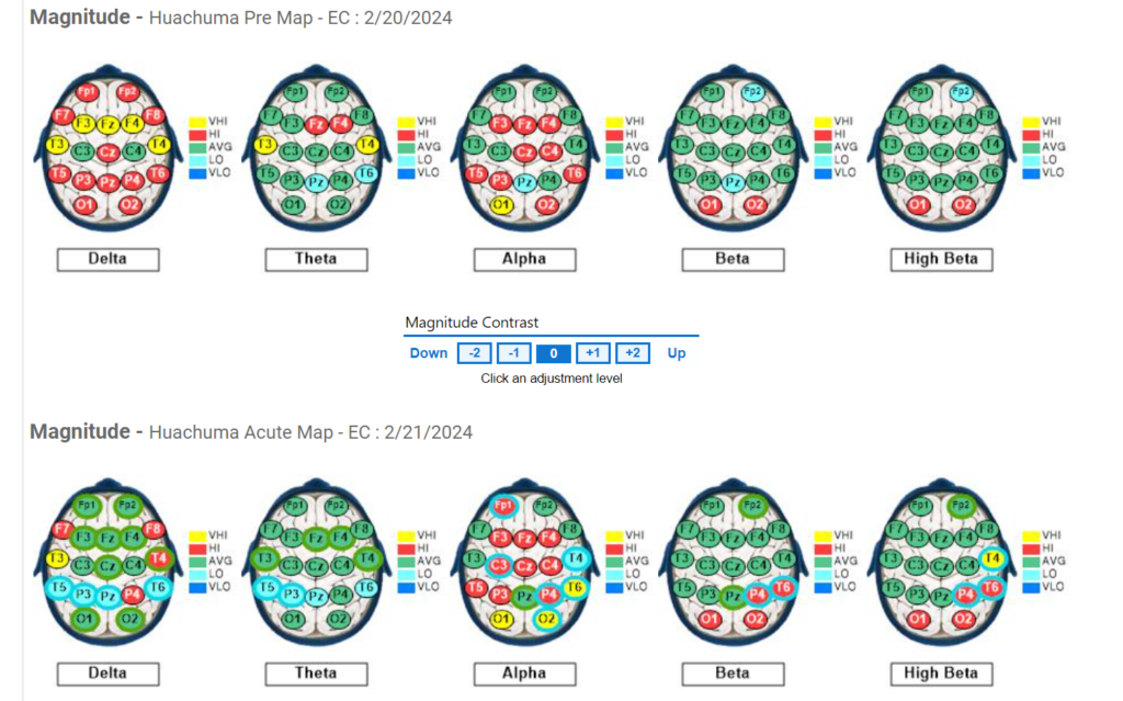 Subject #5 Pre and Acute QEEG results