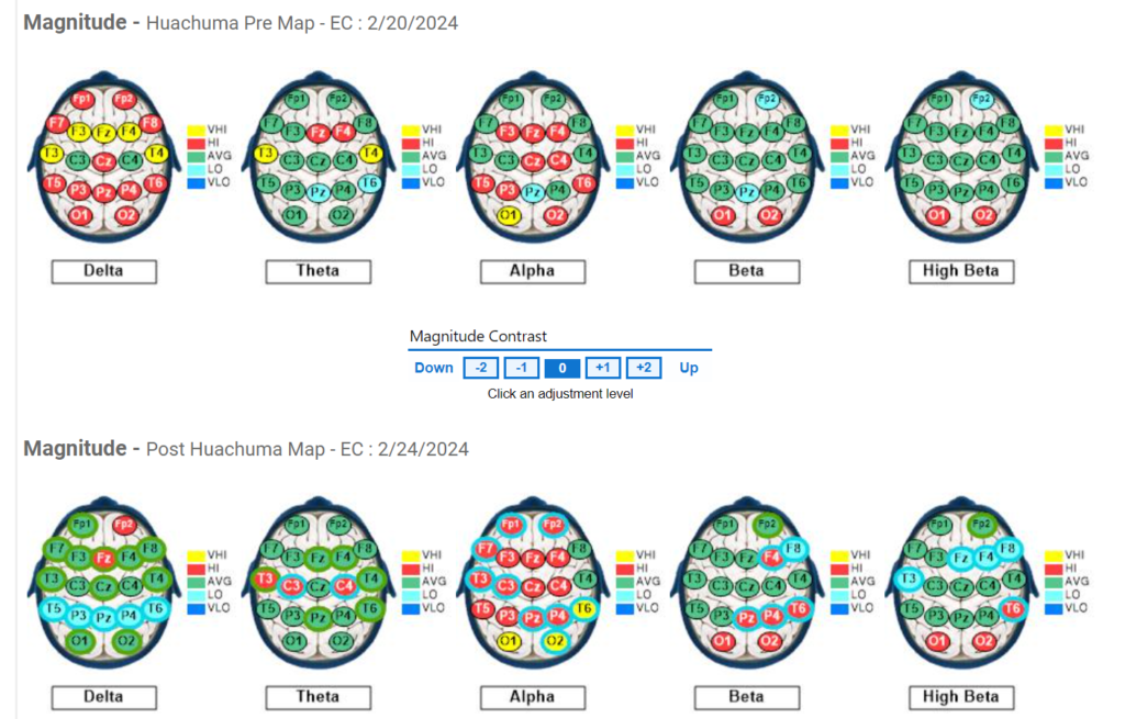 Subject #5 Pre and Post QEEG results