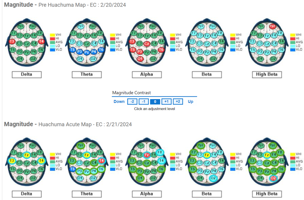 Subject #6 Pre and Acute QEEG results