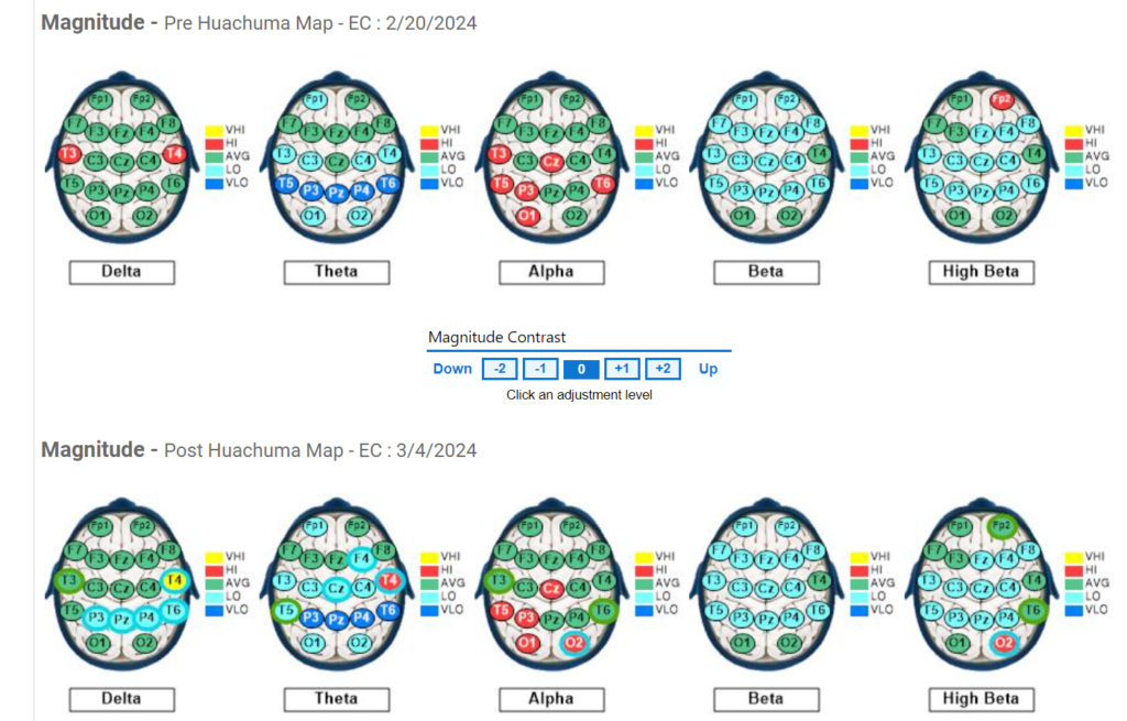 Subject #6 Pre and Post QEEG results