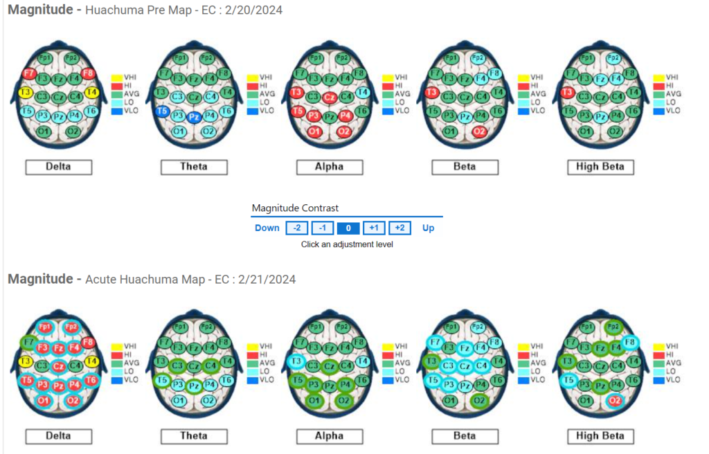 Subject #7 Pre and Acute QEEG results