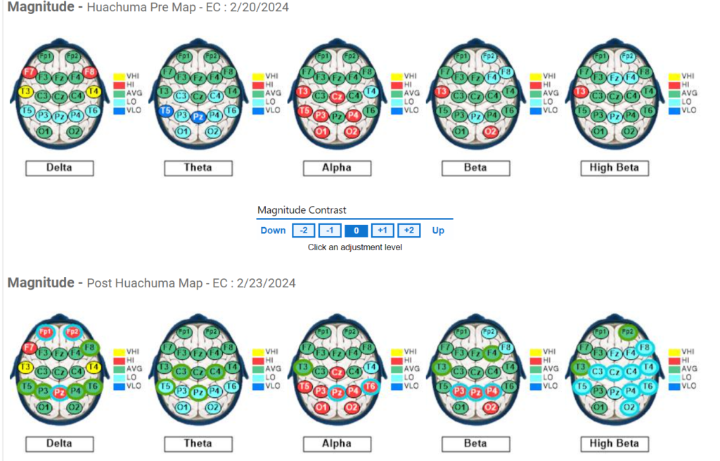 Subject #7 Pre and Post QEEG results