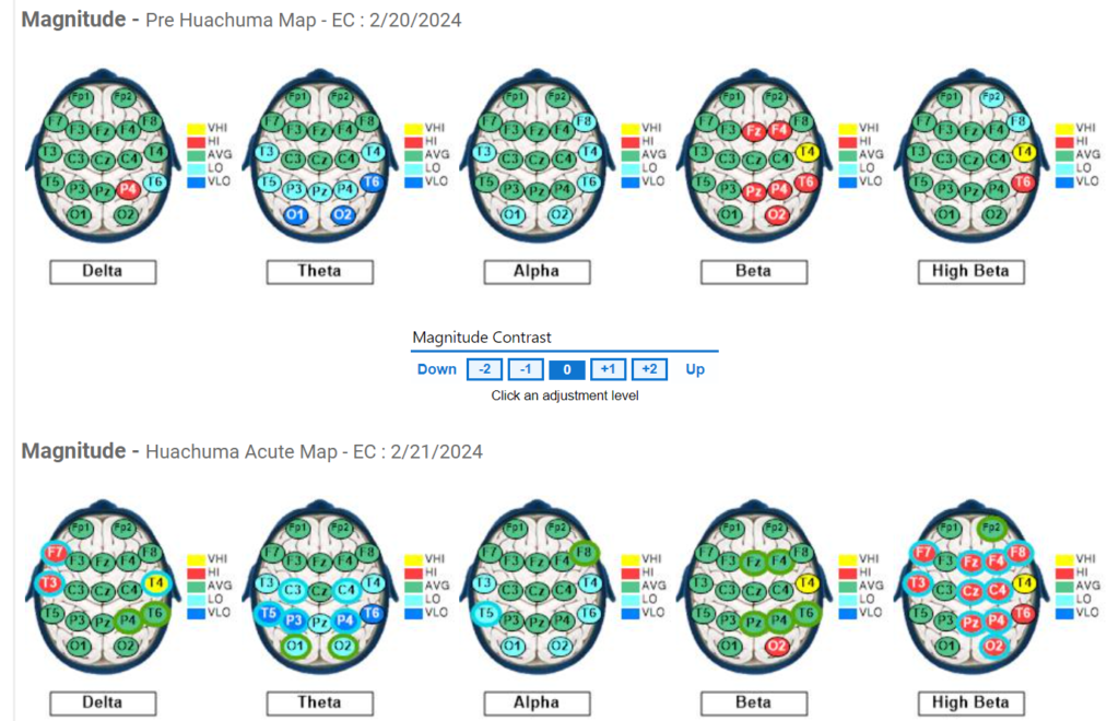 Subject #8 Pre and Acute QEEG results