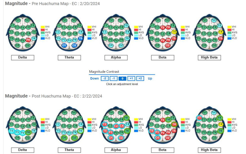 Subject #8 Pre and Post QEEG results