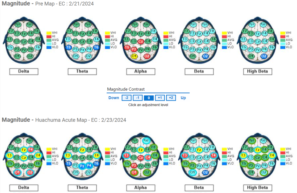 Subject #9 Pre and Acute QEEG results