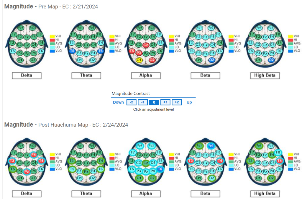 Subject #9 Pre and Post QEEG results